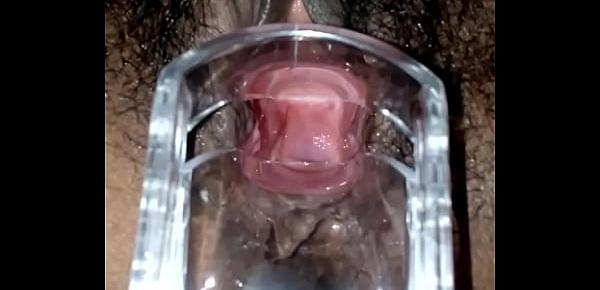  SLIM INDIAN BROWN GIRL CERVIX SPECULUM CHECK VAGINAL OPENING